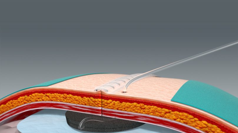 Verschlossene Bauchdecke, lateral
ausgeleitete Drainage