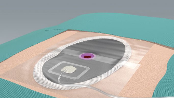Darstellung eines medizinischen Geräts auf der Haut, mit einem Implantat und Verbindungselementen. Aufbringen des Sogkonnektors und Aussc