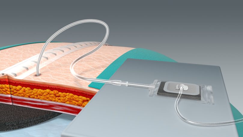 Anschluss des Universaladapters
(PPM-UniAdapt™) an die Unterdruckquelle