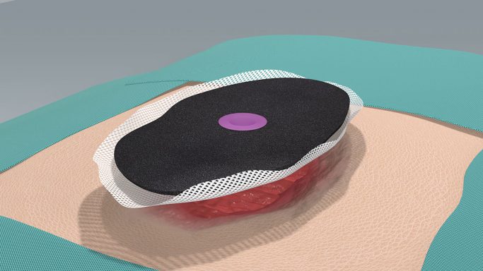 Positionierung des Wundverbandes. Die Öffnung des Adapters muss sich direkt über der Fistel befinden und diese komplett aussparen